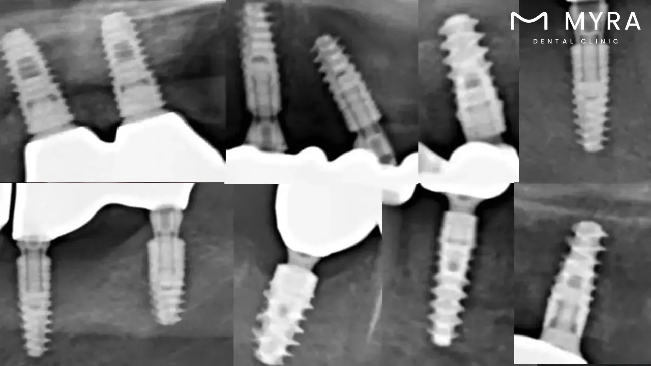 Do different types of dental implants impact the overall limit_.webp
